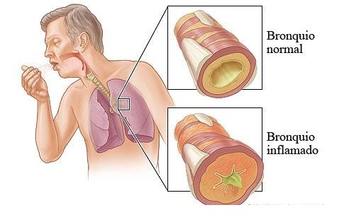 Remedios para la Bronquitis