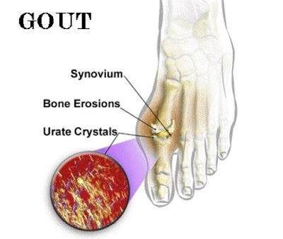 Nguyên nhân gây nên bệnh gout 