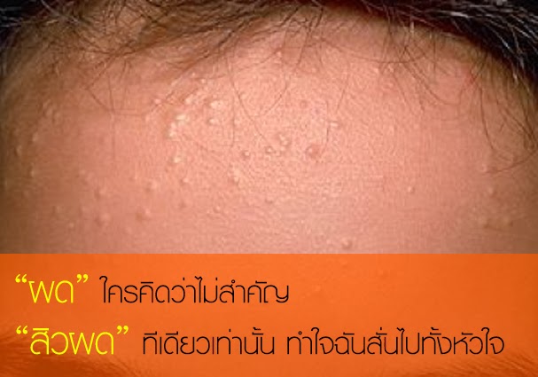 บทความวิธีรักษาสิวผดอย่างได้ผล