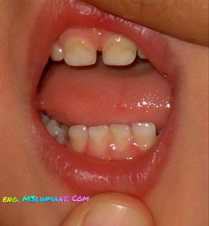 yellow teeth in children