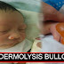 Dumaranas Ng Epidermolysis Bullosa O Kakaibang Sakit Sa Balat Ang Baby Na Ito. Kailangan Niya Ng Tulong Niyo.