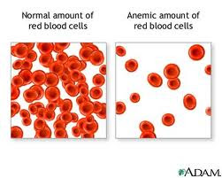 anemia