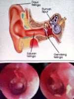 Picture Of Causes Of Otitis Media Or Middle Ear Inflammation, Symptoms And Otitis Media Treatment