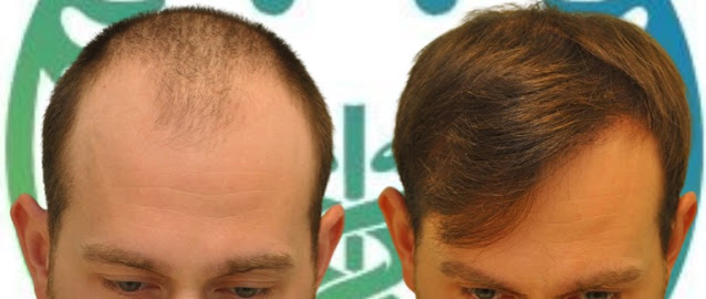 Trapianto di capelli in un uomo di 34 anni a Tirana, prima e dopo 10 mesi