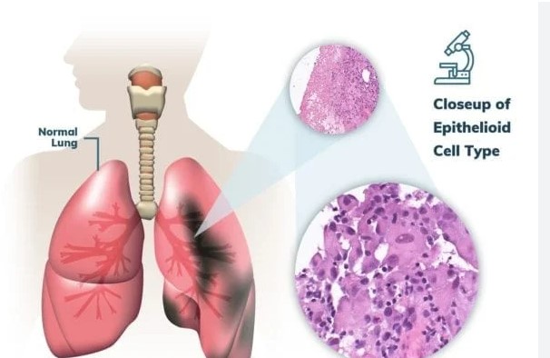  Pericardial Mesothelioma - Symptoms, Diagnosis, Treatment, Prognosis & Basic Facts For You to Know