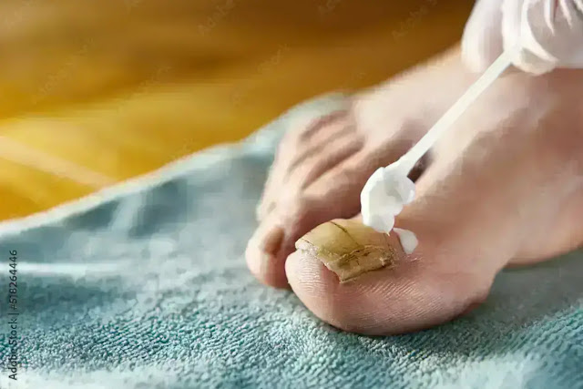 Natural DIY nail fungus remedies