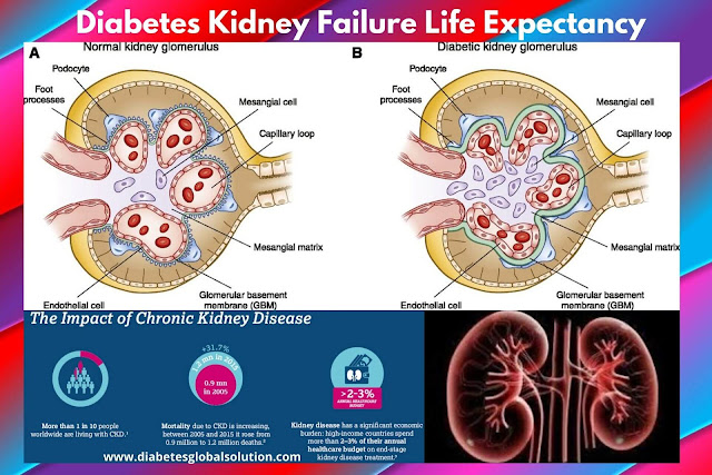 Diabetes Kidney Failure Life Expectancy