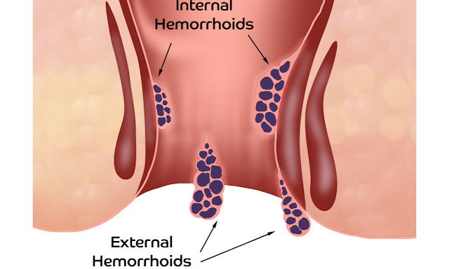 Picture of Internal and External Haemorrhoids