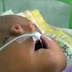 Bebê nasce com dois narizes devido condição genética ultrarrara