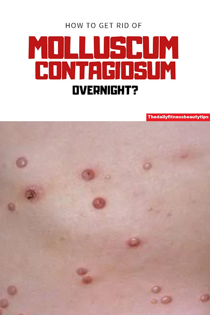 molluscum contagiosum pictures