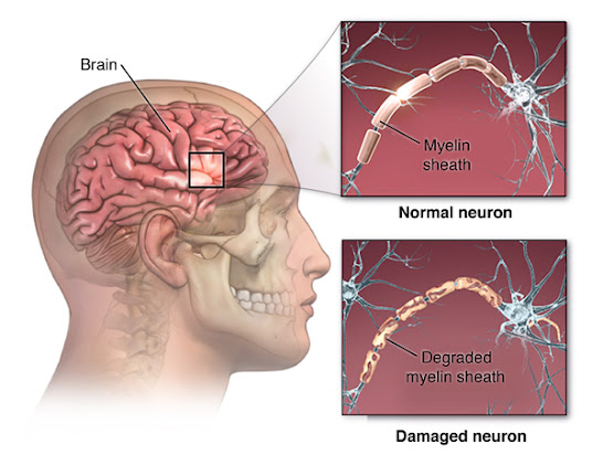 Chronic Inflammatory Demyelinating Polyneuropathy (CIDP) Treatment