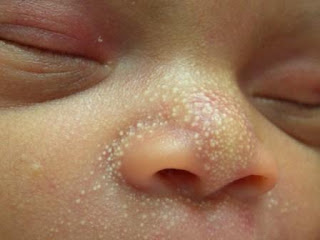 Pimple on Newborn Babies