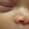 Pimple on Newborn Babies