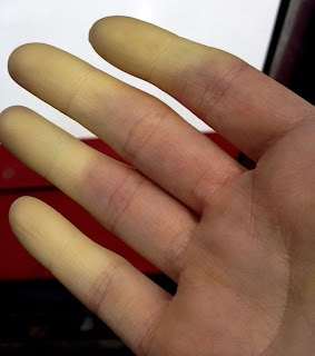 Raynaud's Phenomenon - white fingers on hand