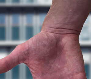 Bier Spots on Hands & Legs Symptoms, Causes, Treatment