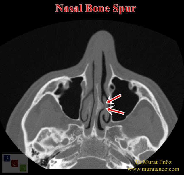 What Is a Nasal Bone Spur? - Nasal Bone Spurs Surgery İstanbul - Nasal Bone Spur Treatment in Turkey - Symptoms of Nasal Bone Spur - Nose Bone Spur Formation - Contact Point Headaches - Diagnosis of Nasal Bone Spur - Removal of a Septal Bone Spur - Atypical Headache - Osteophyte - Bone Spur of Nose - Nasal Bone Spur - Bony Nasal Septal Spur