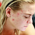 types of pimples How to treat different types of acne