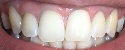 example of my teeth before using the carbon coco kit