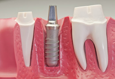  Cấy ghép răng với implant có tốt không?
