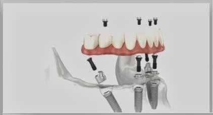 All on Four Dental Implants