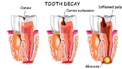 Áp xe chân răng là gì? Điều trị như thế nào?-2