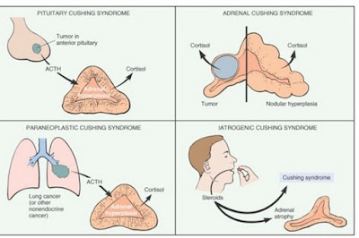Cushing's Disease Pictures