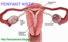 obat (jamu) kista alami, tradisional, herbal