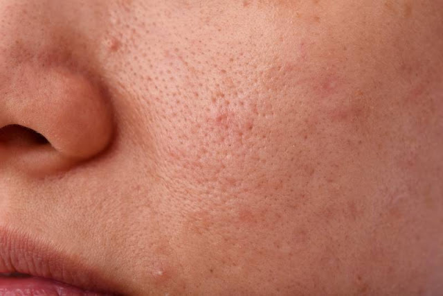 Perawatan kulit wajah untuk menyamarkan pori-pori dan memperbaiki tekstur kulit