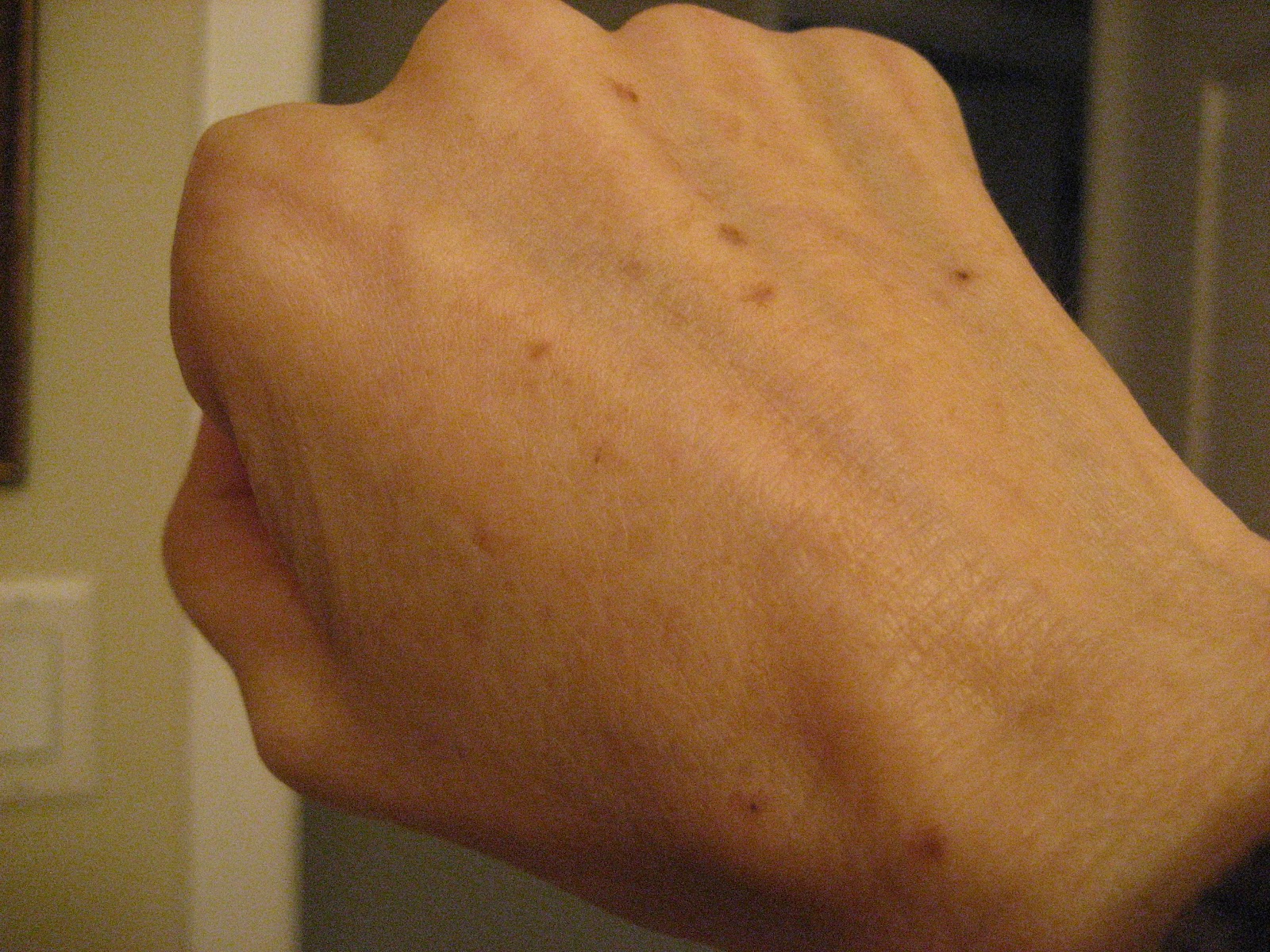  Spots On Hands Chemical peels for acne and anti aging: hand age spots