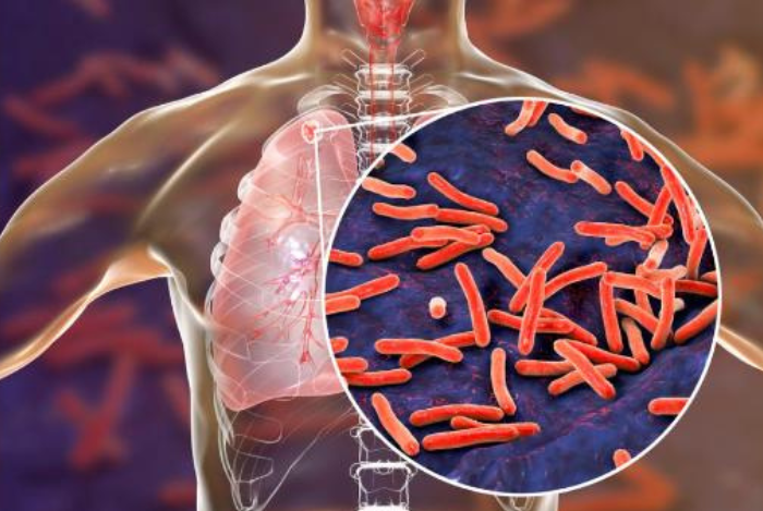 Interferon Gamma Release Assay (IGRA) Tes Imunoserologi Untuk Tuberculosis