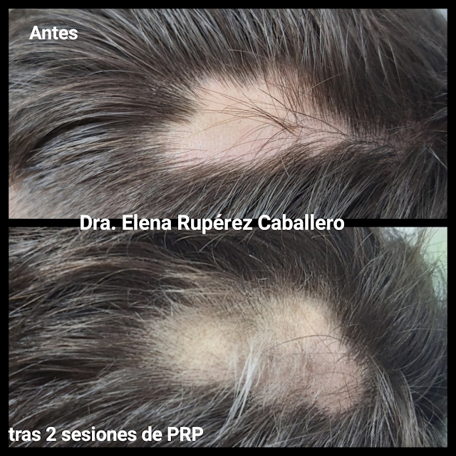 Alopecia areata post estres!!