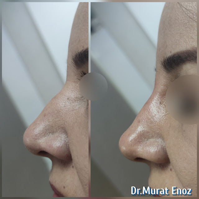 Non-surgical nose job, Nose filler injection Istanbul, Liquid rhinoplasty, Nose camouflage with filler, Nose reshaping with filler