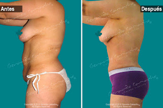 Lipoabdominoplastia Colombia