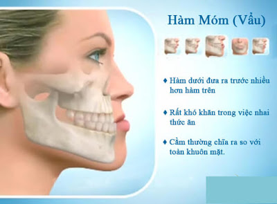 Các dấu hiệu nhận biết bệnh nhân bị vẩu hàm dưới