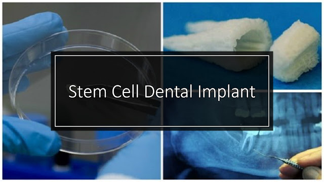 stem cell dental implant