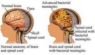 bacterial infection