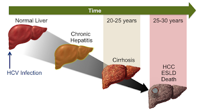 Cara Mengobati Hepatitis Paling Ampuh