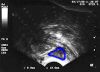 low antral count does not equal fertility problems