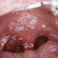 cara mengobati herpes mulut