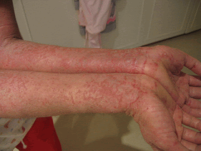 Eczema Symptoms, Skin Inflammation Signs, Skin Disease Definition