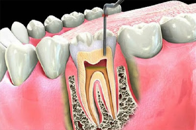 Có nên lấy tủy răng sâu không?