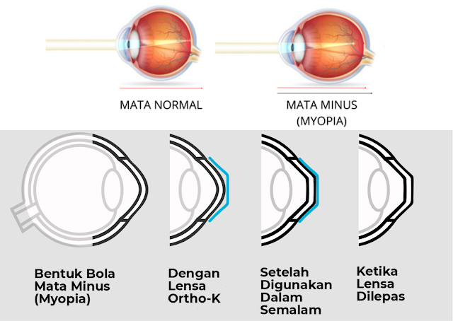 Bebas Mata Minus Tanpa Operasi