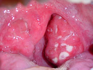 Mal di gola - Farmaco e Cura