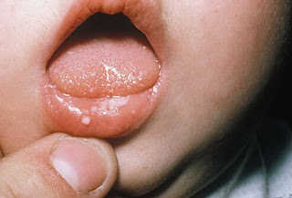Fungal Infections In The Mouth