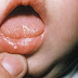 Fungal Infections In The Mouth