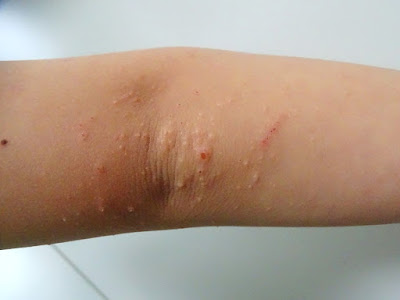 [最も共有された！ √] 丘 しん 皮膚 写真 272276