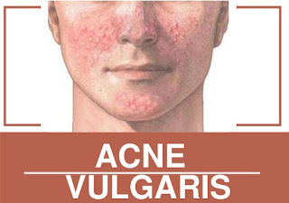 Tackling everything concerning acne vulgaris 