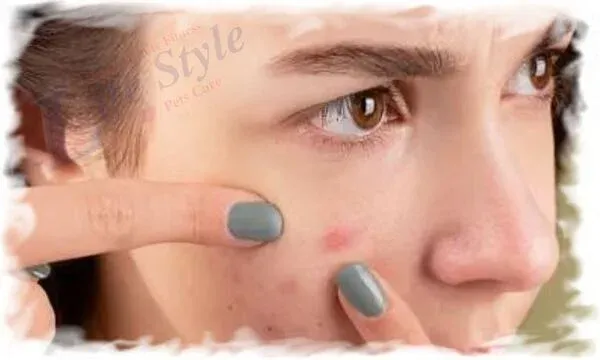 Acne. What is acne causes and treatments