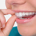 Niềng răng invisalign bao nhiêu tiền