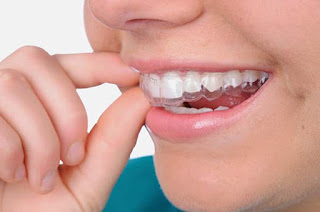 Niềng răng invisalign bao nhiêu tiền-1